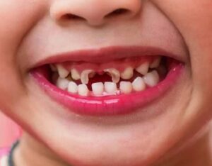 Read more about the article How to Stop Cavities in Kids (Age-Wise Checklist)