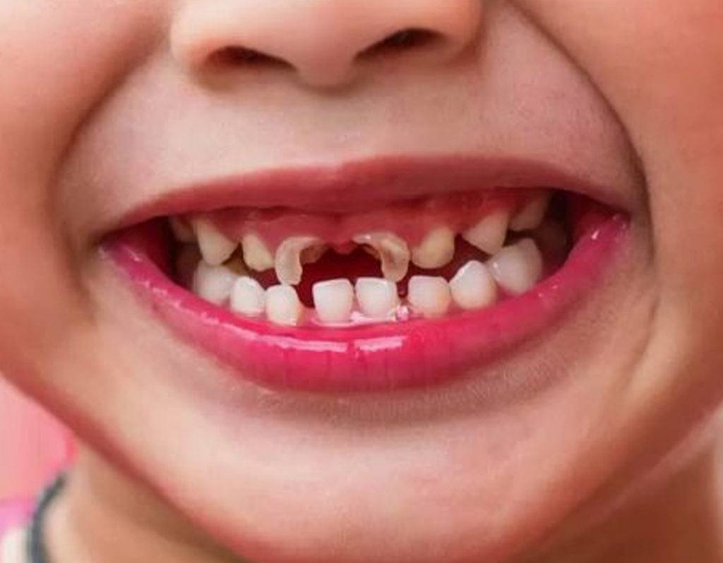 You are currently viewing How to Stop Cavities in Kids (Age-Wise Checklist)