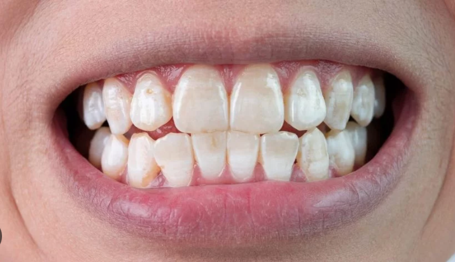 You are currently viewing My Child’s Tooth Turned Grey After a Fall: Should I Be Worried?