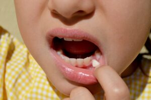 Read more about the article Loose Tooth but Not Falling Out: Is It Normal in Children?