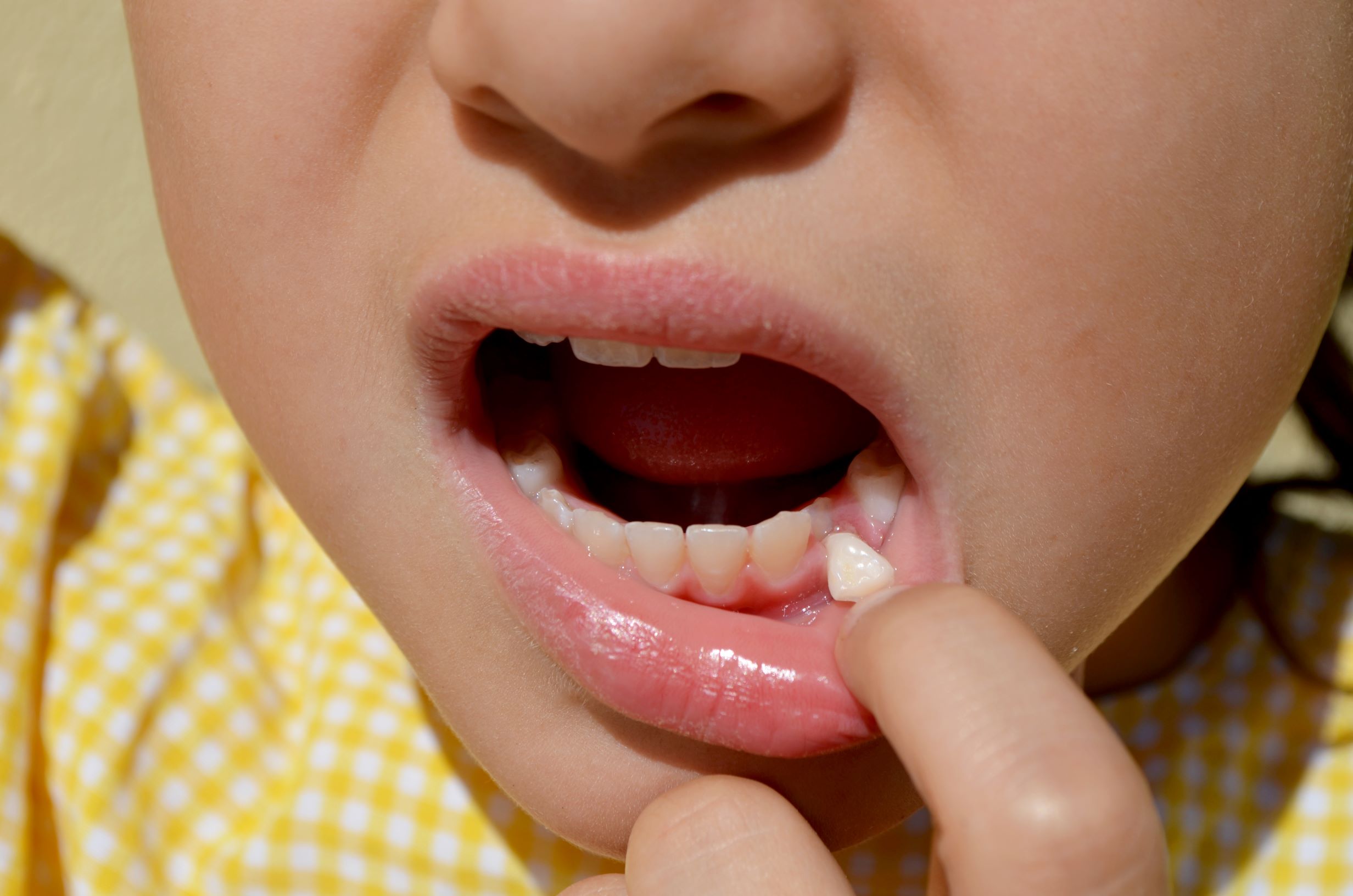 Read more about the article Loose Tooth but Not Falling Out: Is It Normal in Children?