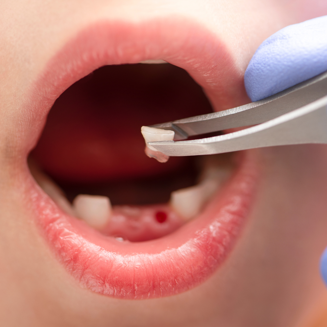 Read more about the article When Do Baby Teeth Fall Out? A Parent’s Timeline Guide